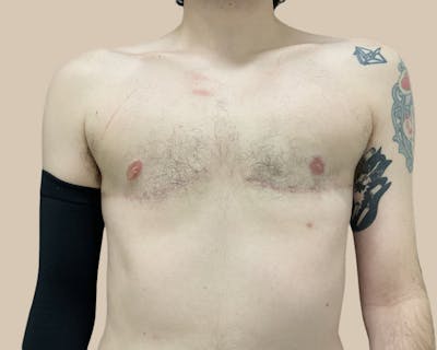 Top Surgery Before & After Gallery - Patient 116729 - Image 2