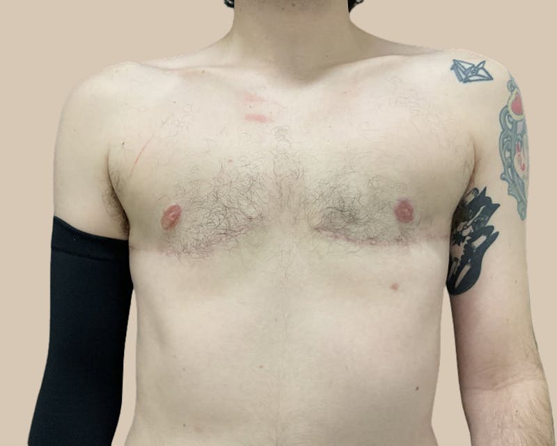 Top Surgery Before & After Gallery - Patient 116729 - Image 2