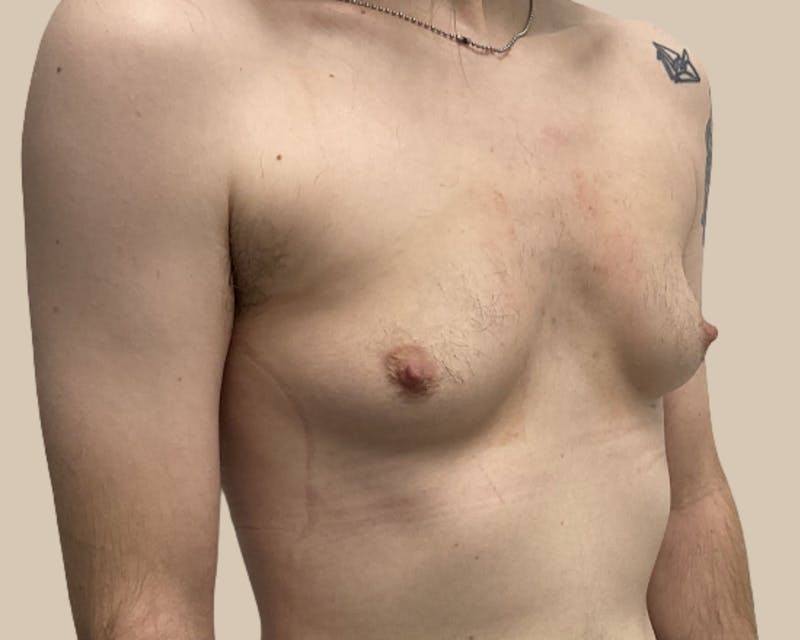 Top Surgery Before & After Gallery - Patient 116729 - Image 5