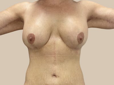 Breast Lift Before & After Gallery - Patient 463882 - Image 2