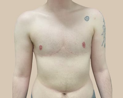 Top Surgery Before & After Gallery - Patient 176866 - Image 2