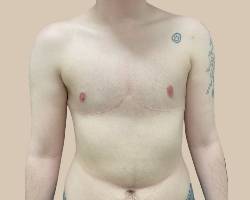Top Surgery Before & After Gallery - Patient 176866 - Image 2