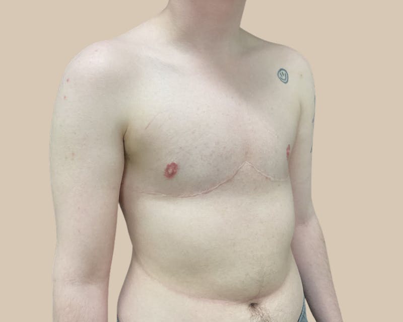 Top Surgery Before & After Gallery - Patient 176866 - Image 4