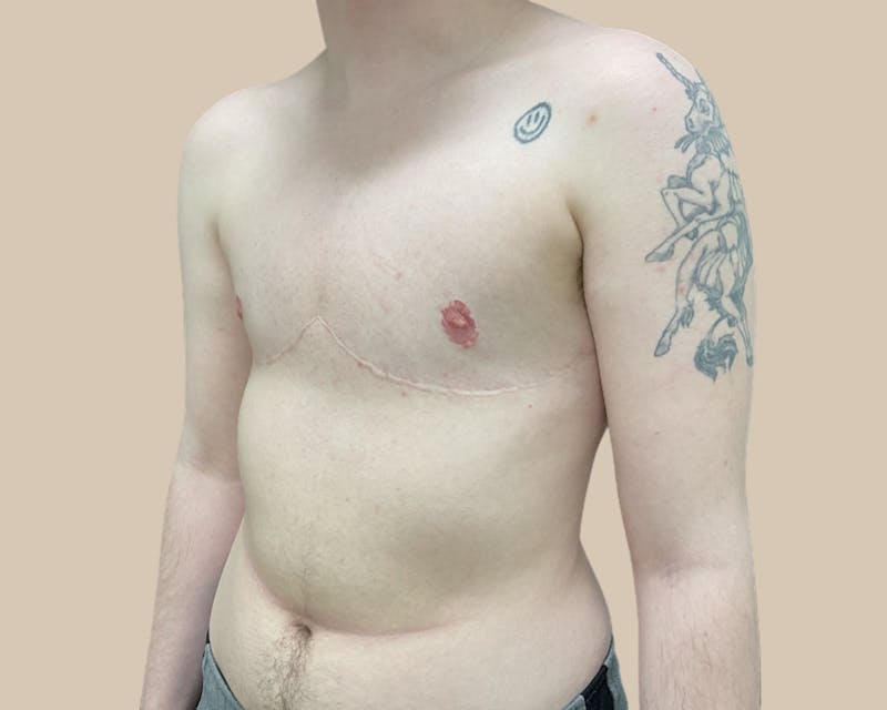 Top Surgery Before & After Gallery - Patient 176866 - Image 6