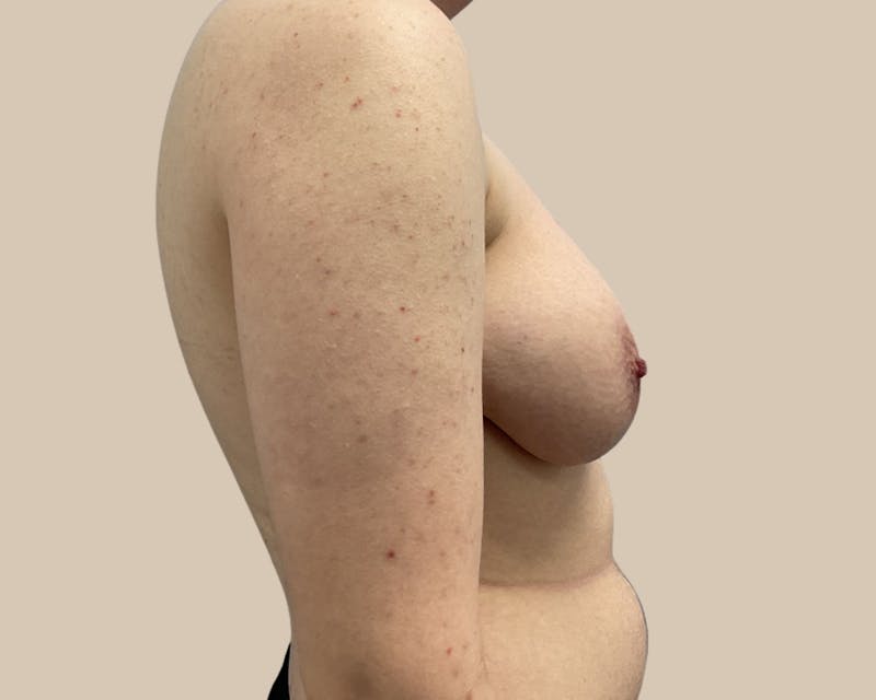 Top Surgery Before & After Gallery - Patient 176866 - Image 7