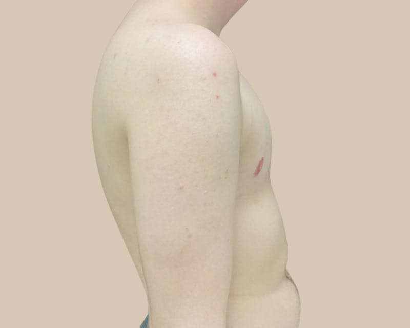 Top Surgery Before & After Gallery - Patient 176866 - Image 8