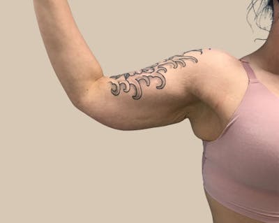 Brachioplasty Before & After Gallery - Patient 362717 - Image 1