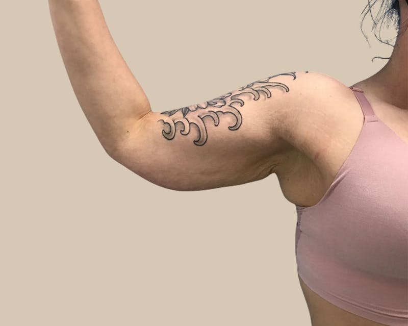 Brachioplasty Before & After Gallery - Patient 362717 - Image 1