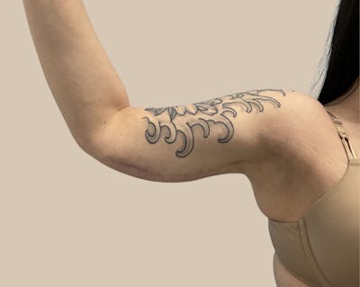 Brachioplasty Before & After Gallery - Patient 362717 - Image 2
