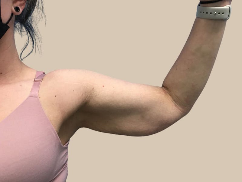 Brachioplasty Before & After Gallery - Patient 362717 - Image 3