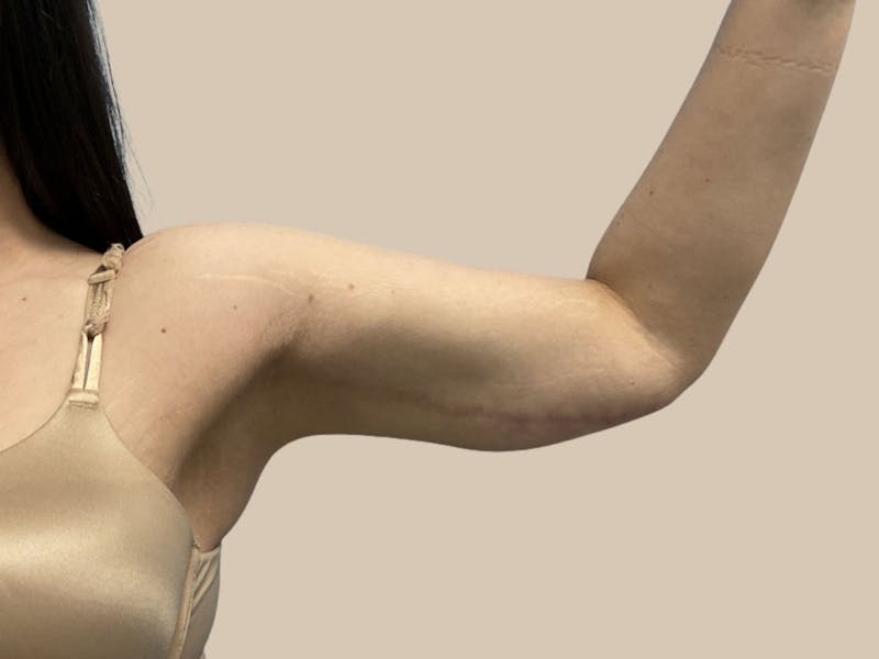 Brachioplasty Before & After Gallery - Patient 362717 - Image 4