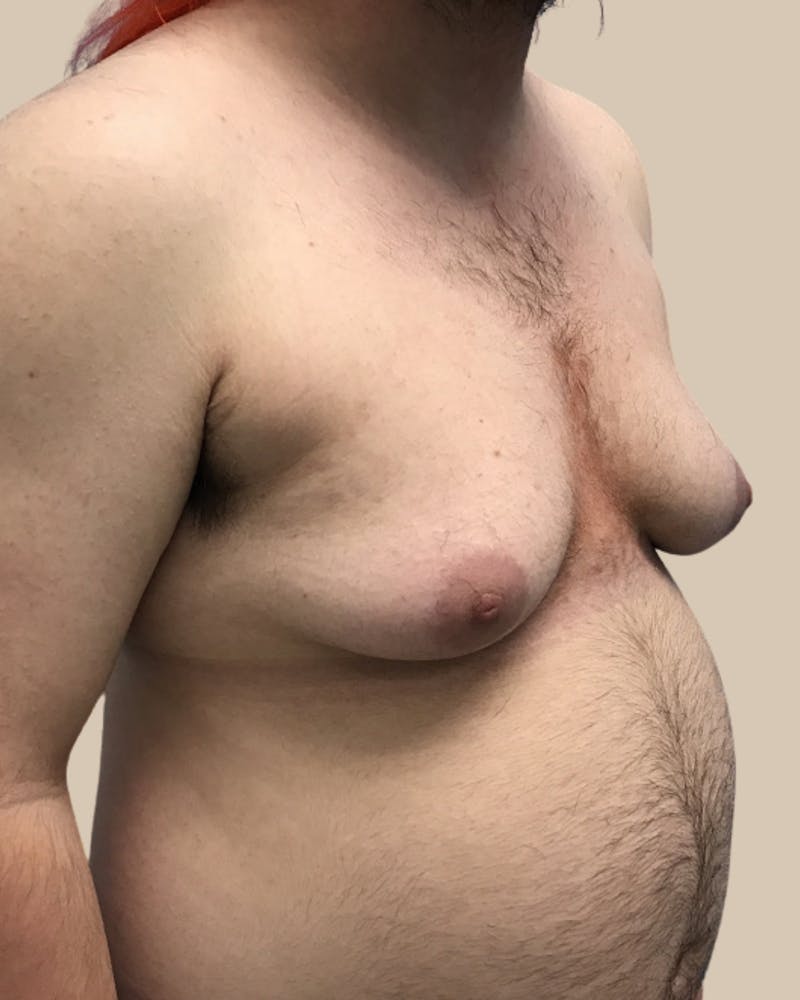 Top Surgery Before & After Gallery - Patient 176677 - Image 5