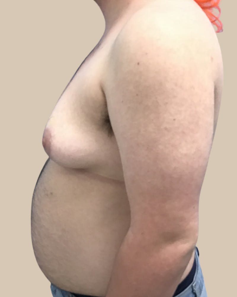 Top Surgery Before & After Gallery - Patient 176677 - Image 3