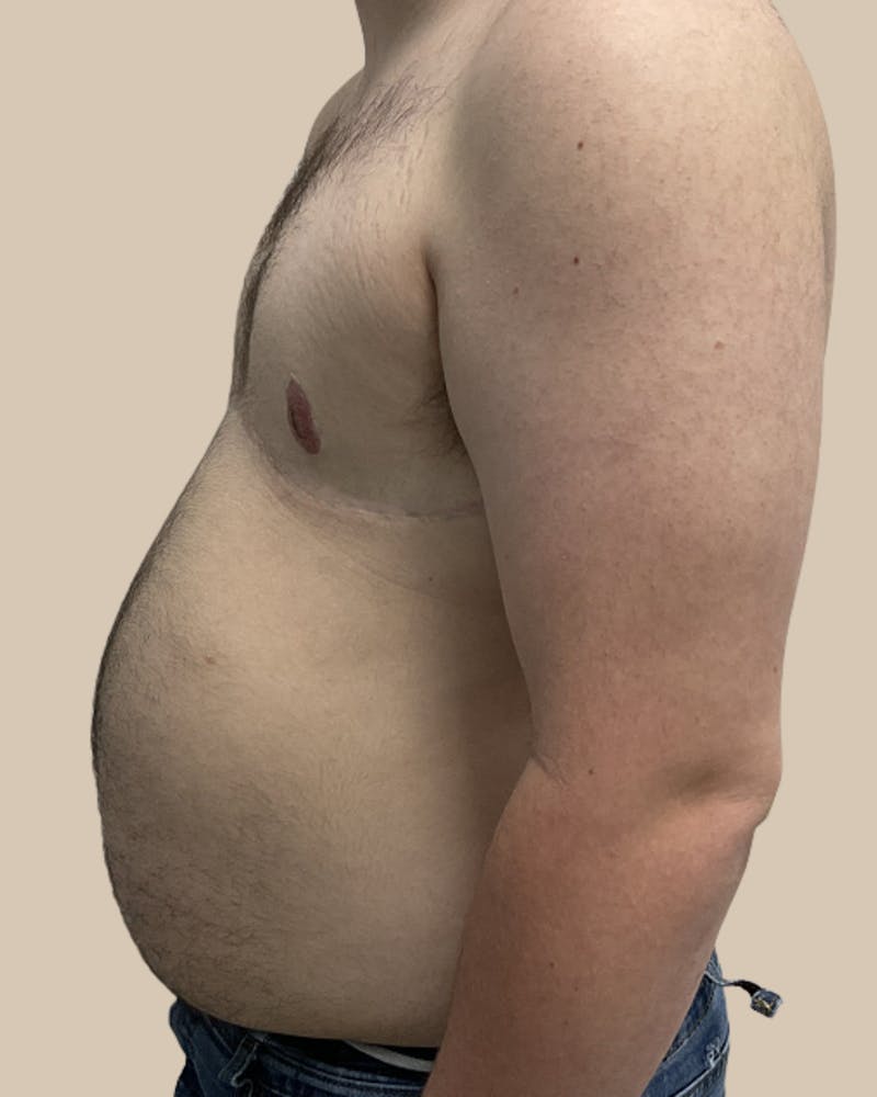 Top Surgery Before & After Gallery - Patient 176677 - Image 4
