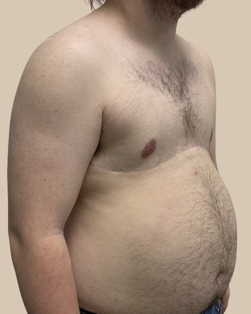 Top Surgery Before & After Gallery - Patient 176677 - Image 6