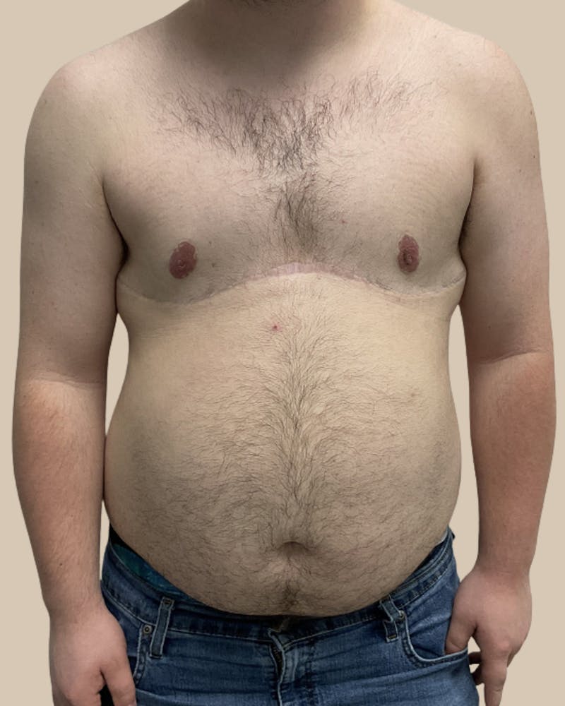 Top Surgery Before & After Gallery - Patient 176677 - Image 2