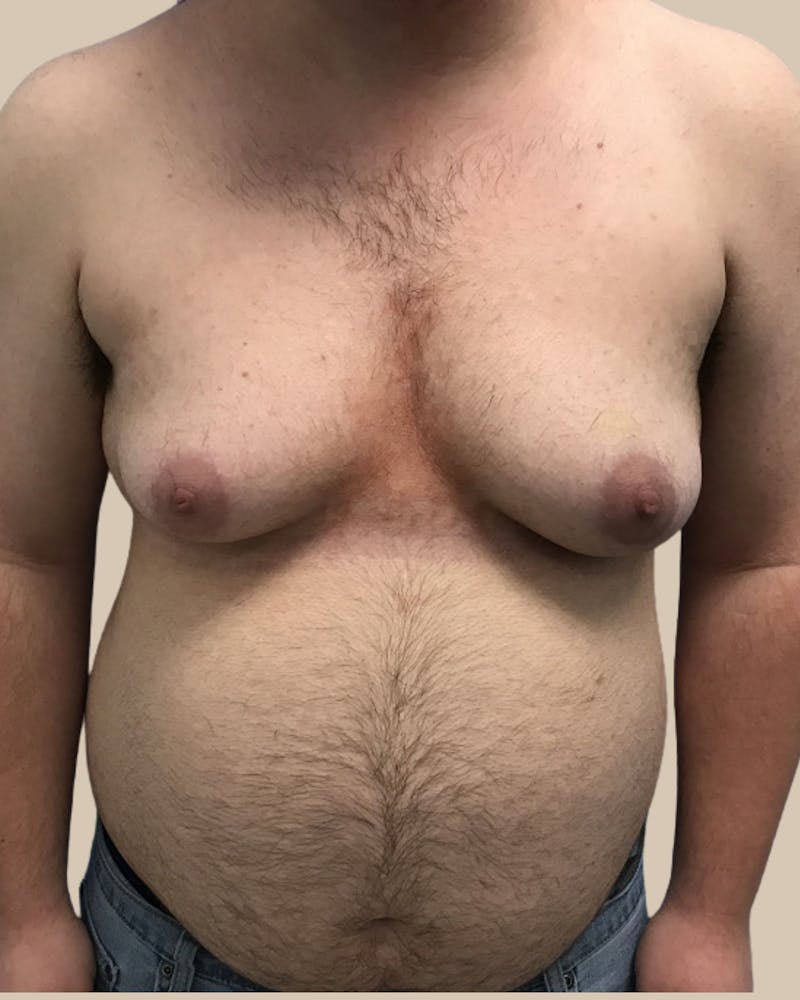 Top Surgery Before & After Gallery - Patient 176677 - Image 1