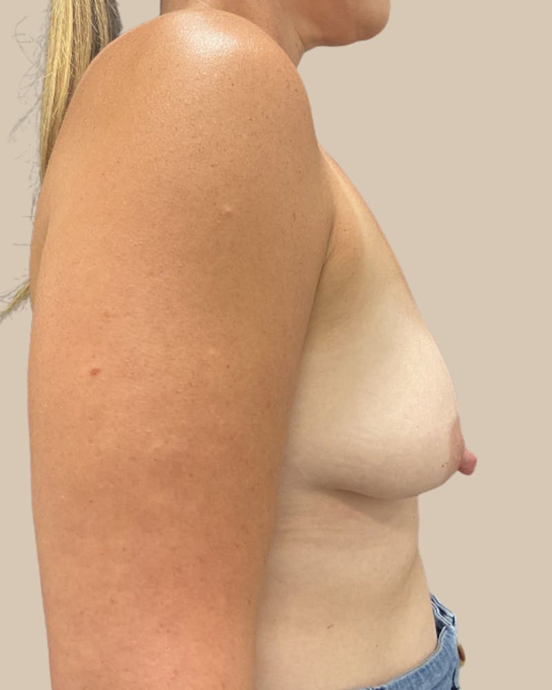 Breast Lift with Augmentation Before & After Gallery - Patient 888362 - Image 7
