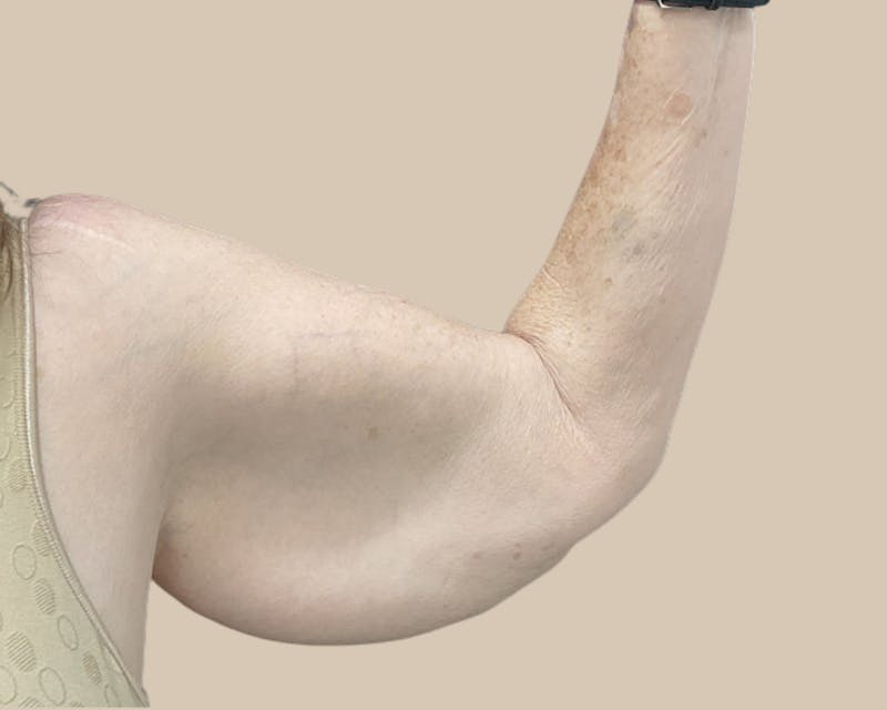 Brachioplasty Before & After Gallery - Patient 154047 - Image 3