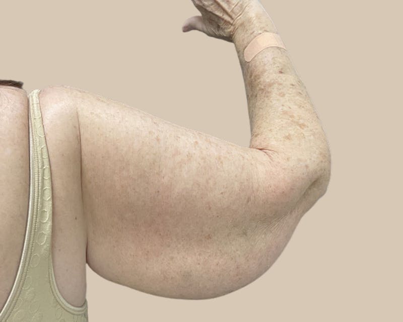 Brachioplasty Before & After Gallery - Patient 154047 - Image 5