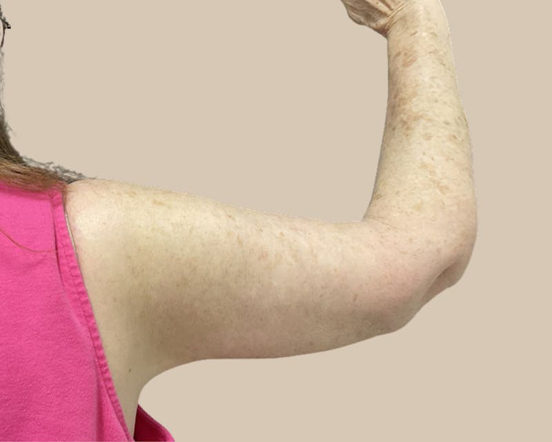 Brachioplasty Before & After Gallery - Patient 154047 - Image 6