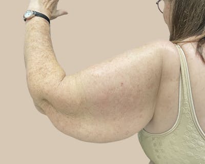 Brachioplasty Before & After Gallery - Patient 154047 - Image 1