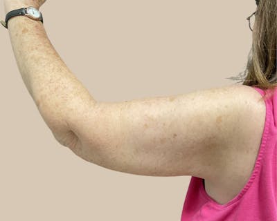 Brachioplasty Before & After Gallery - Patient 154047 - Image 2