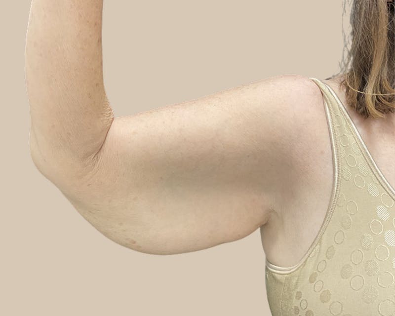 Brachioplasty Before & After Gallery - Patient 154047 - Image 7