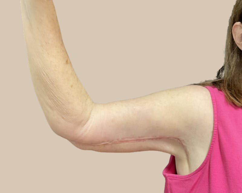 Brachioplasty Before & After Gallery - Patient 154047 - Image 8