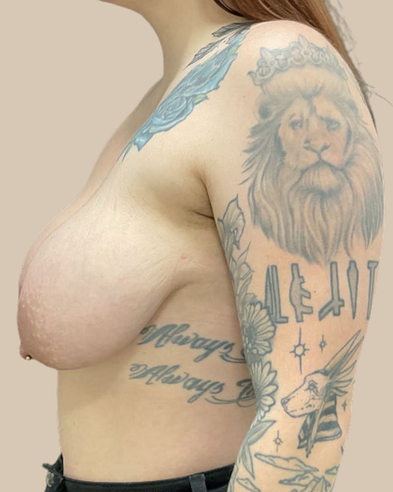 Breast Lift Before & After Gallery - Patient 143078 - Image 5