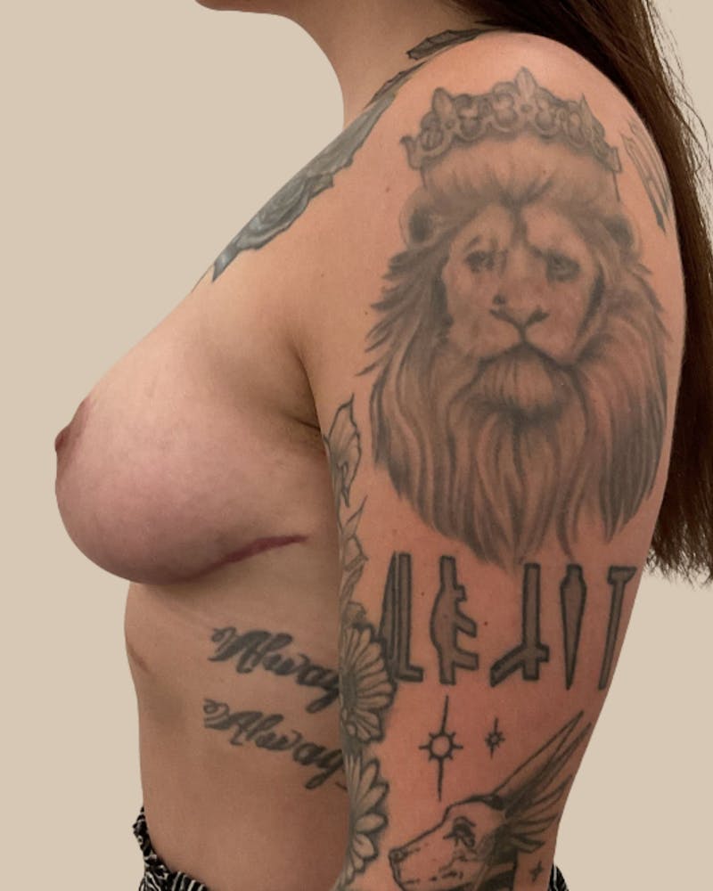 Breast Lift Before & After Gallery - Patient 143078 - Image 6