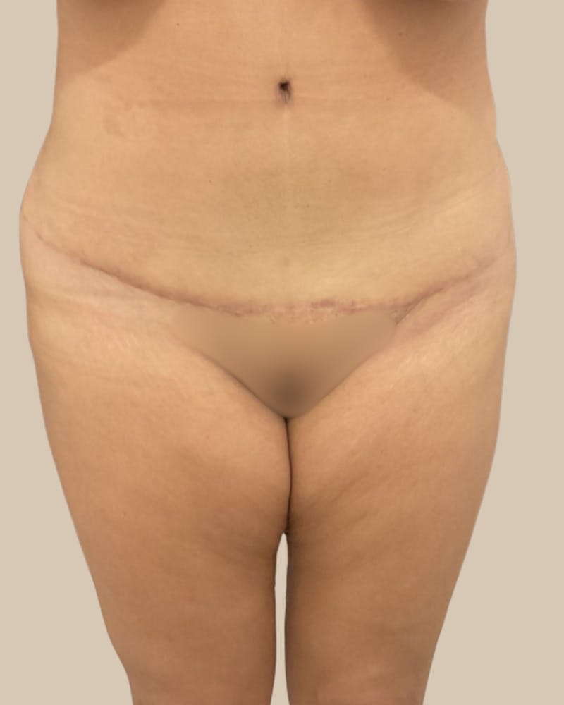 Tummy Tuck Before & After Gallery - Patient 178388 - Image 2