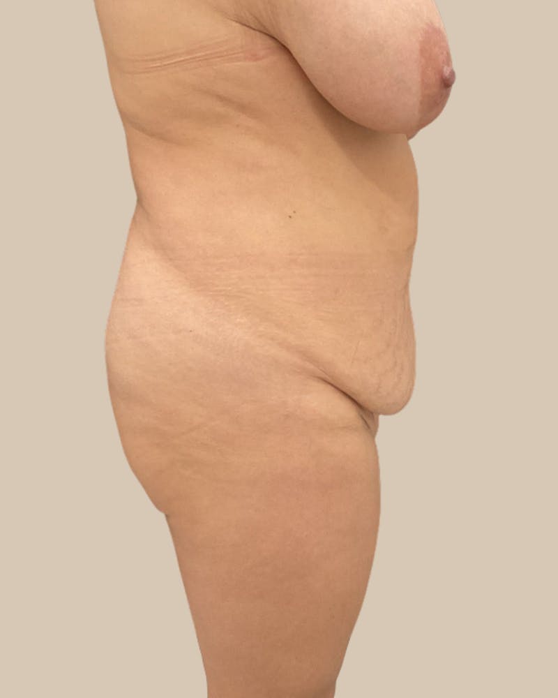 Tummy Tuck Before & After Gallery - Patient 178388 - Image 3