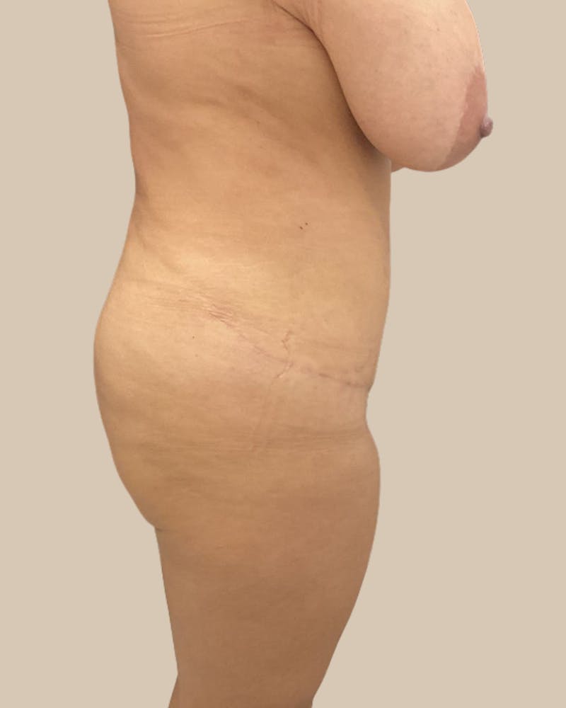 Tummy Tuck Before & After Gallery - Patient 178388 - Image 4