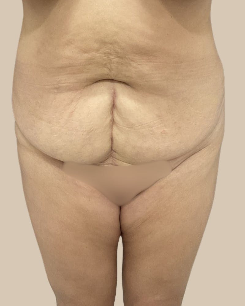 Tummy Tuck Before & After Gallery - Patient 178388 - Image 1