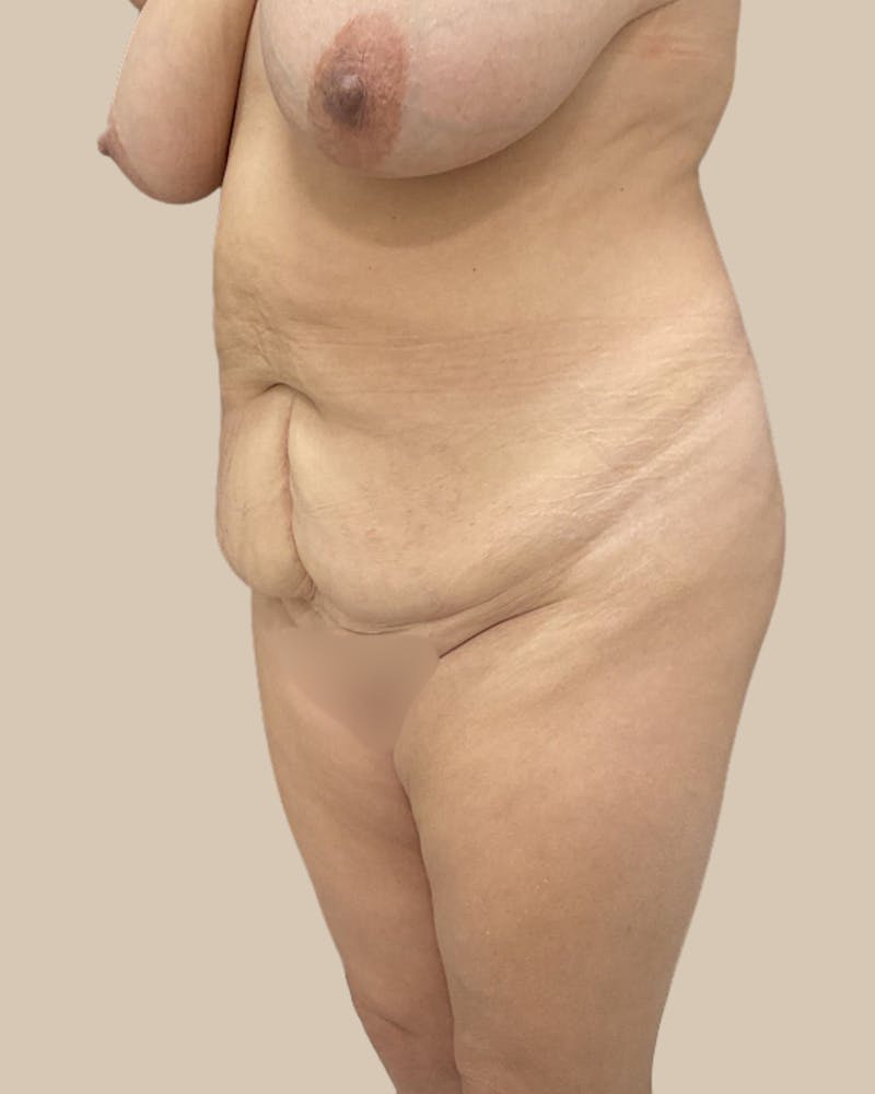 Tummy Tuck Before & After Gallery - Patient 178388 - Image 9