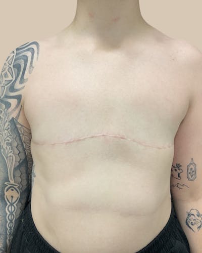 Top Surgery Before & After Gallery - Patient 412104 - Image 2