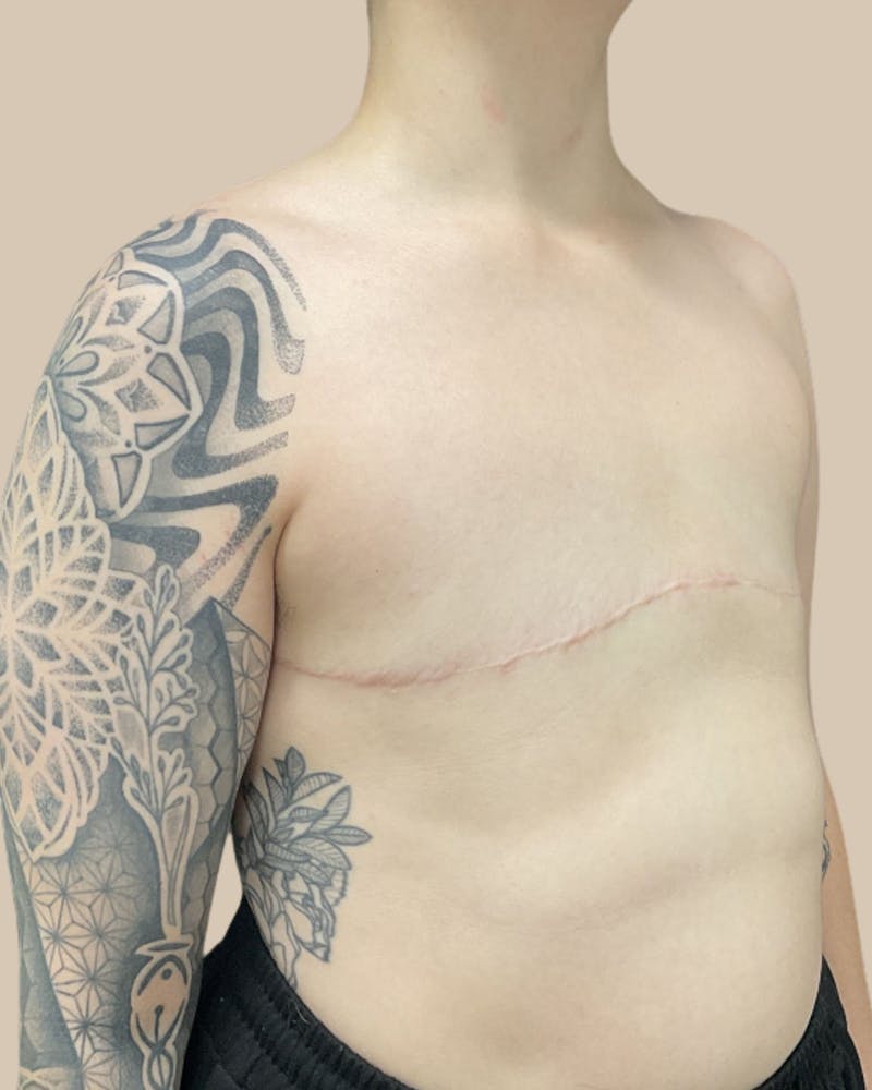 Top Surgery Before & After Gallery - Patient 412104 - Image 4