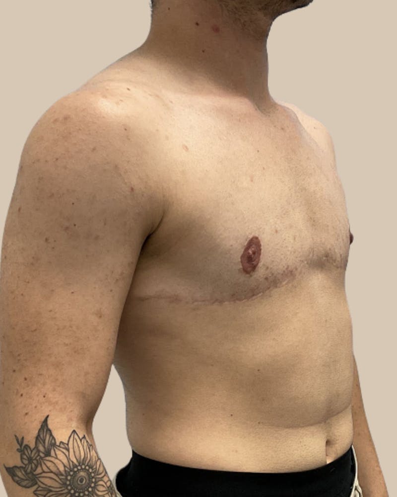 Top Surgery Before & After Gallery - Patient 313629 - Image 4