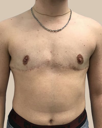 Top Surgery Before & After Gallery - Patient 313629 - Image 2