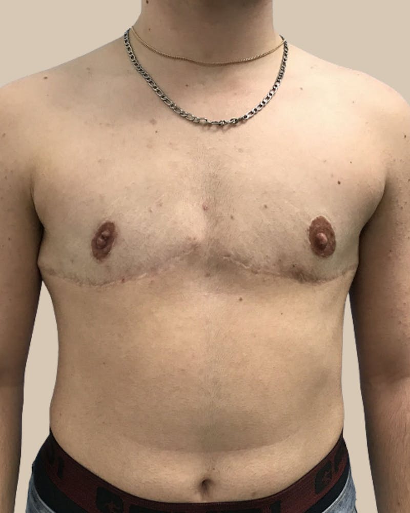Top Surgery Before & After Gallery - Patient 313629 - Image 2