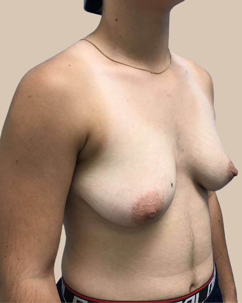 Top Surgery Before & After Gallery - Patient 313629 - Image 3