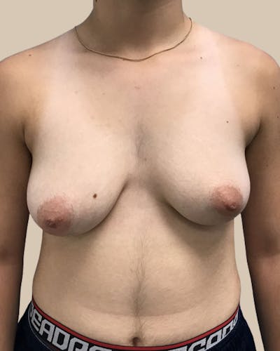 Top Surgery Before & After Gallery - Patient 313629 - Image 1