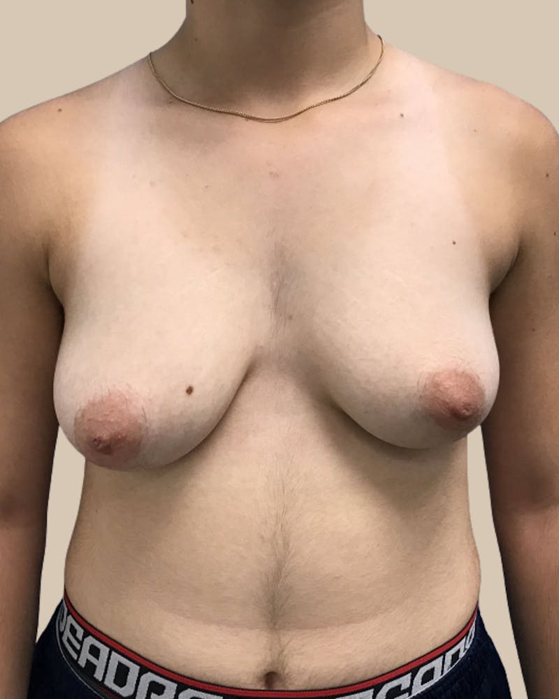 Top Surgery Before & After Gallery - Patient 313629 - Image 1