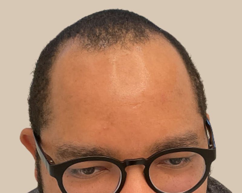 Hair Restoration Before & After Gallery - Patient 802138 - Image 1