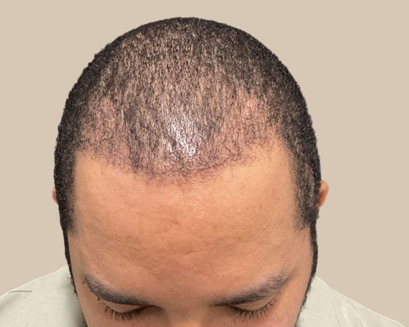 Hair Restoration Before & After Gallery - Patient 802138 - Image 2