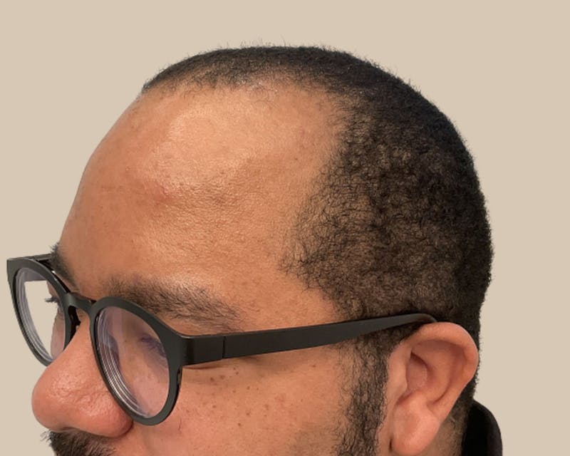 Hair Restoration Before & After Gallery - Patient 802138 - Image 5
