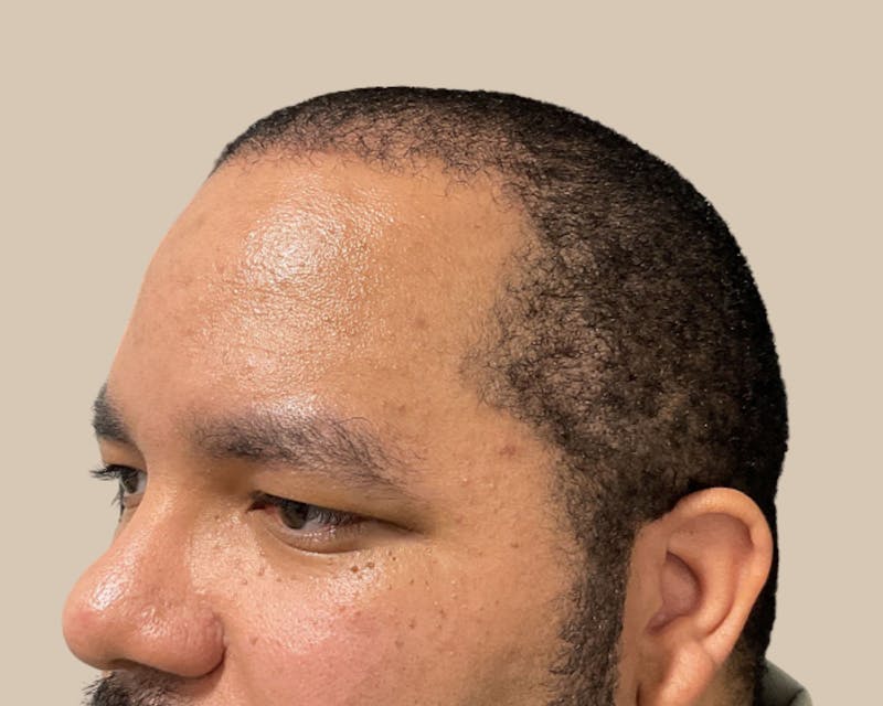 Hair Restoration Before & After Gallery - Patient 802138 - Image 6