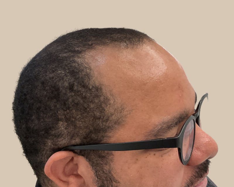Hair Restoration Before & After Gallery - Patient 802138 - Image 3