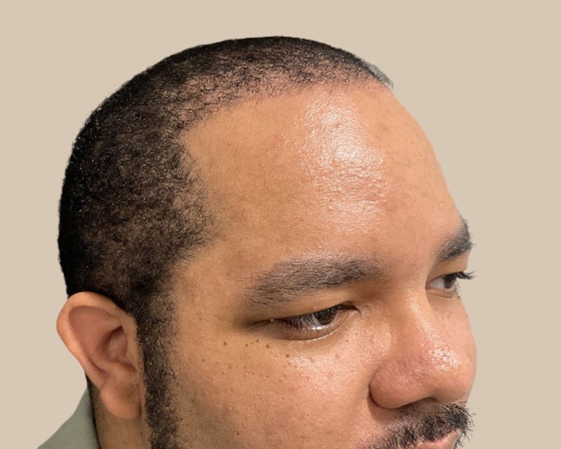 Hair Restoration Before & After Gallery - Patient 802138 - Image 4